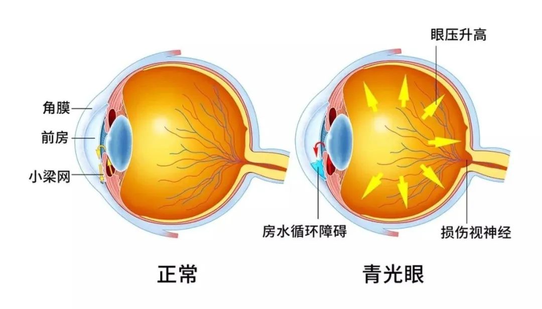 沈阳开发区医院官网（沈阳经济技术开发区）,青光眼