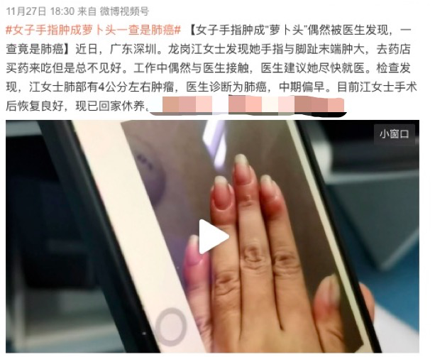 沈阳经济技术开发区人民医院官网（开发区医院）,末端指节增宽增厚